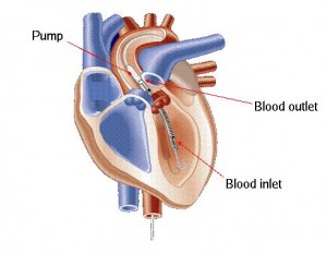 plaatje_hart_AMC